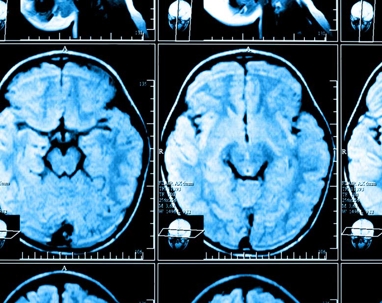 Brain injury